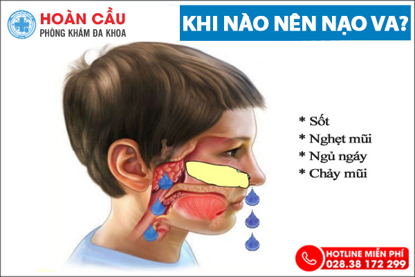 Có nên nạo VA không? là băn khoăn của nhiều bệnh nhân