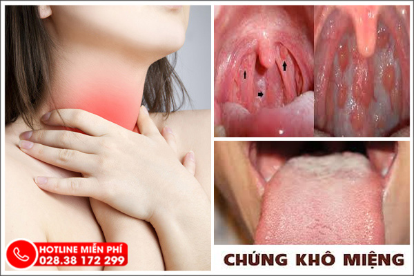 Khô họng - triệu chứng cảnh báo nhiều bệnh lý nguy hiểm